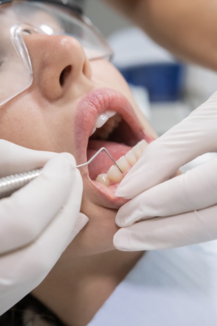 Tooth Filling